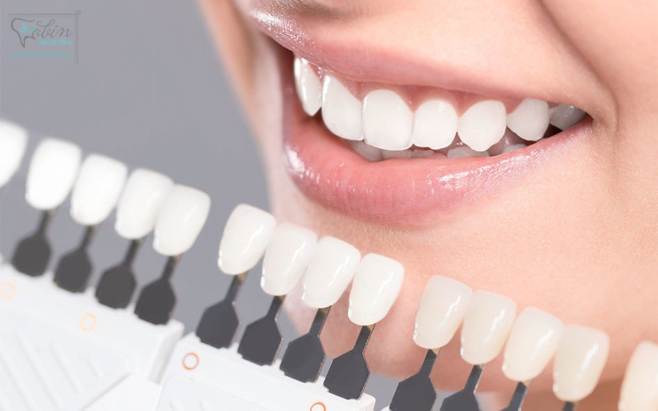 پاسخگویی به سوالات متداول کامپوزیت دندان